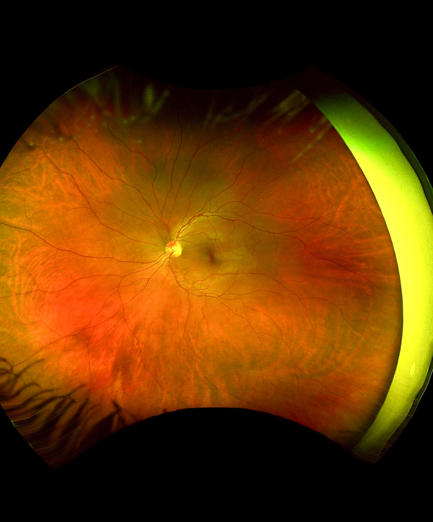 Digital image of the inside of an eye, showing the retina, optic nerve and blood vessels.